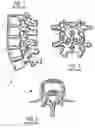 Fig. 02 - Guide pin for pedicle screw placement and method for use of such guide pin in spinal fusion surgeries