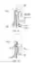 Fig. 09 - TRANSVASCULAR NEURAL STIMULATION DEVICE
