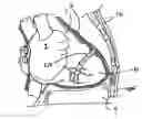 Fig. 01 - Implanted cardiac device for defibrillation