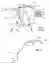 Fig. 02 - Implanted cardiac device for defibrillation