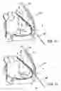 Fig. 06 - Implanted cardiac device for defibrillation