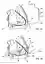 Fig. 07 - Implanted cardiac device for defibrillation