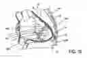 Fig. 08 - Implanted cardiac device for defibrillation