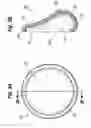 Fig. 04 - FORM STABLE BREAST IMPLANT SIZER AND METHOD OF USE