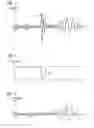 Fig. 02 - Method for attenuating interfering noise and corresponding hearing device