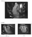 Fig. 07 - Dynamic pulmonary trunk modeling in computed tomography and magnetic resonance imaging based on the detection of bounding boxes, anatomical landmarks, and ribs of a pulmonary artery