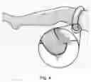 Fig. 04 - Medical device and a method for applying a biochemically active material on one or more body parts
