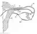 Fig. 01 - Occlusion of fallopian tubes