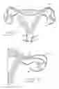 Fig. 02 - Occlusion of fallopian tubes