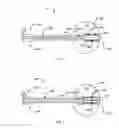 Fig. 02 - Selectable multi-lumen brachytherapy devices and methods