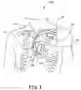 Fig. 02 - Method and apparatus to terminate ventricular tachycardia via pacing