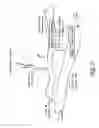 Fig. 02 - Method for permanent occlusion of fallopian tube