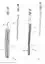 Fig. 03 - Method for permanent occlusion of fallopian tube