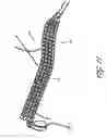 Fig. 14 - Method for permanent occlusion of fallopian tube