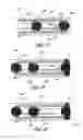 Fig. 19 - Method for permanent occlusion of fallopian tube