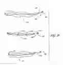 Fig. 35 - Method for permanent occlusion of fallopian tube