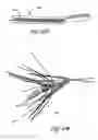 Fig. 43 - Method for permanent occlusion of fallopian tube