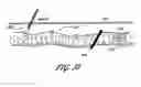 Fig. 46 - Method for permanent occlusion of fallopian tube