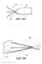Fig. 51 - Method for permanent occlusion of fallopian tube