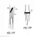 Fig. 53 - Method for permanent occlusion of fallopian tube