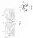 Fig. 04 - Endoprosthesis having flexible connectors