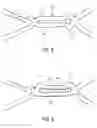 Fig. 04 - Endoprosthesis having struts linked by foot extensions