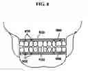 Fig. 07 - Intermaxillary fixation device and method of using same