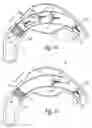 Fig. 06 - Endovascular graft with separately positionable and removable frame units