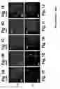 Fig. 02 - CNS-tumor treatment method and composition