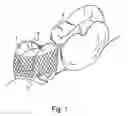 Fig. 02 - MATRIX BAND