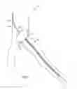 Fig. 02 - Methods and systems for placement of a stent adjacent an ostium
