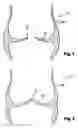 Fig. 02 - Prosthesis for Ascending Aortic Segment and Method for Surgical Treatment of an Aortic Valve Leak