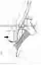 Fig. 02 - Device for treatment of acromioclavicular joint dislocations