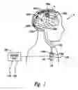 Fig. 02 - Apparatus and methods for applying neural stimulation to a patient