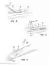 Fig. 03 - APPARATUS AND METHOD FOR ACHIEVING MICROPUNCTURE