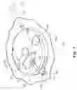 Fig. 09 - Burr hole anchors, systems, and methods