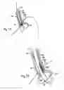 Fig. 09 - SURGICAL INSTRUMENTS AND TECHNIQUES FOR TREATING GASTRO-ESOPHAGEAL REFLUX DISEASE