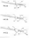 Fig. 04 - Gastric retaining devices and methods