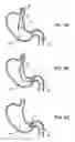 Fig. 08 - Gastric retaining devices and methods