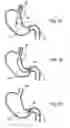 Fig. 09 - Gastric retaining devices and methods