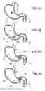 Fig. 10 - Gastric retaining devices and methods