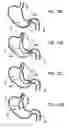 Fig. 12 - Gastric retaining devices and methods