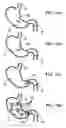 Fig. 16 - Gastric retaining devices and methods