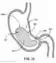 Fig. 19 - Gastric retaining devices and methods