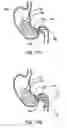 Fig. 20 - Gastric retaining devices and methods