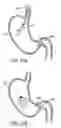 Fig. 24 - Gastric retaining devices and methods