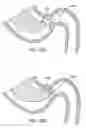 Fig. 25 - Gastric retaining devices and methods