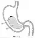 Fig. 26 - Gastric retaining devices and methods