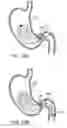Fig. 27 - Gastric retaining devices and methods