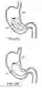 Fig. 28 - Gastric retaining devices and methods